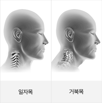 거북목증후군